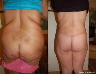 Bodylift - Dr Luc Vanrenterghem