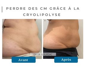 Cryolipolyse - Dr Catherine de Goursac