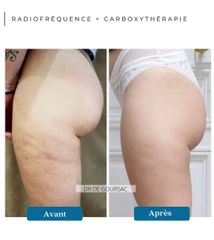 Radiofréquence et Carboxythérapie - Dr Catherine de Goursac