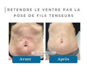 Fils tenseurs - Dr Catherine de Goursac