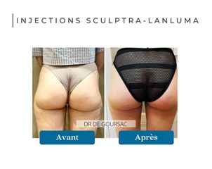 Acide hyaluronique - Dr Catherine de Goursac