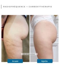 Radiofréquence - Dr Catherine de Goursac