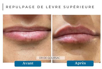 Repulpage de lèvre supérieure - Dr Catherine de Goursac