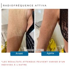 Radiofréquence - Dr Catherine de Goursac