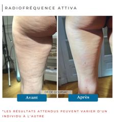 Radiofréquence - Dr Catherine de Goursac