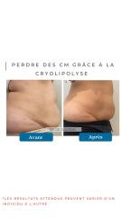 Cryolipolyse - Dr De Goursac