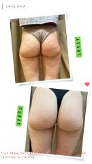 Injections Lanluma - Dr de Goursac