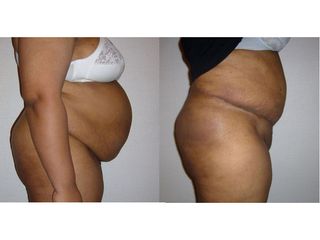 Avant après Abdominoplastie