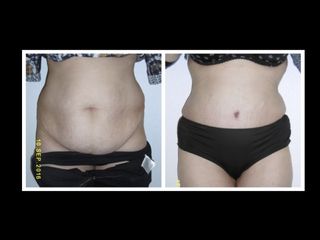 Avant après Abdominoplastie
