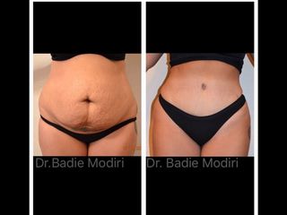 Avant après Abdominoplastie