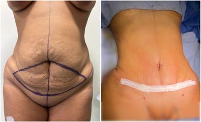 Abdominoplastie - Dr Behzad Badie Modiri
