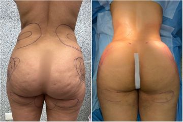 Chirurgie des fesses - Dr Behzad Badie Modiri