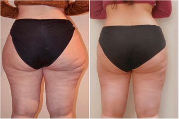 Liposuccion - Dr Behzad Badie Modiri