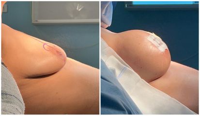 Augmentation mammaire - Dr Behzad Badie Modiri