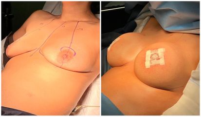 Augmentation mammaire - Dr Behzad Badie Modiri
