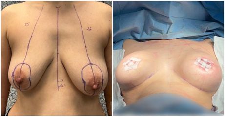Mastopexie - Dr Behzad Badie Modiri