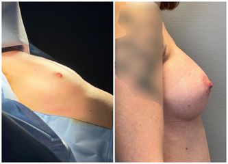 Augmentation mammaire - Dr Behzad Badie Modiri