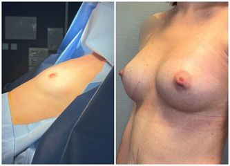 Augmentation mammaire - Dr Behzad Badie Modiri