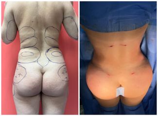 Liposuccion - Dr Behzad Badie Modiri