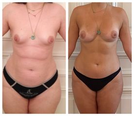 Lipofilling Dr Donatella Negro