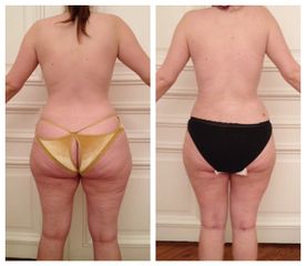 Liposuccion Dr Donatella Negro