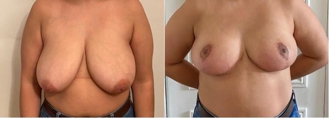 Réduction mammaire - Dr Donatella Negro