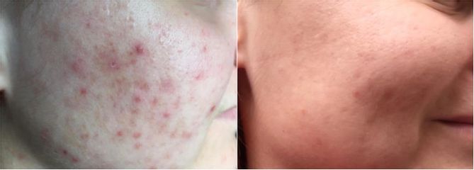 Traitement anti-acné - Dr Donatella Negro
