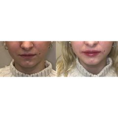 Augmentation des lèvres - Dr Eugenio Broccaioli