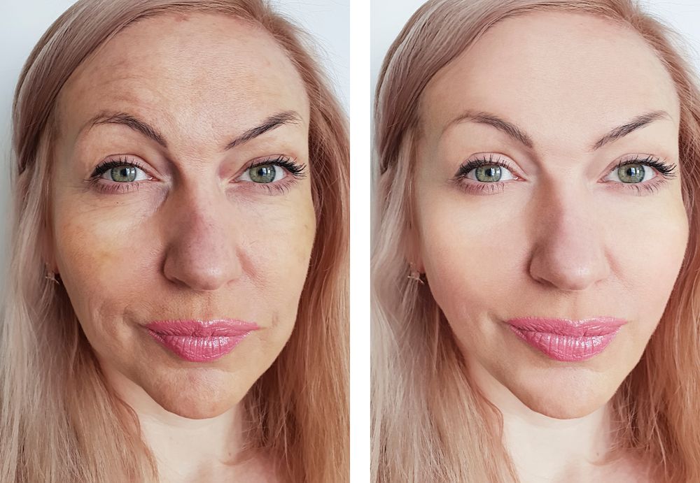 Skin Resurfacing Prima e Dopo