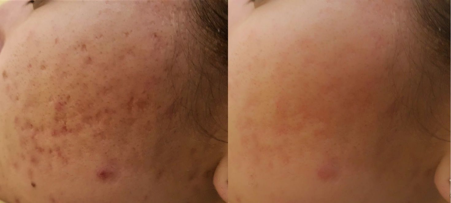Trattamento acne, prima e dopo
