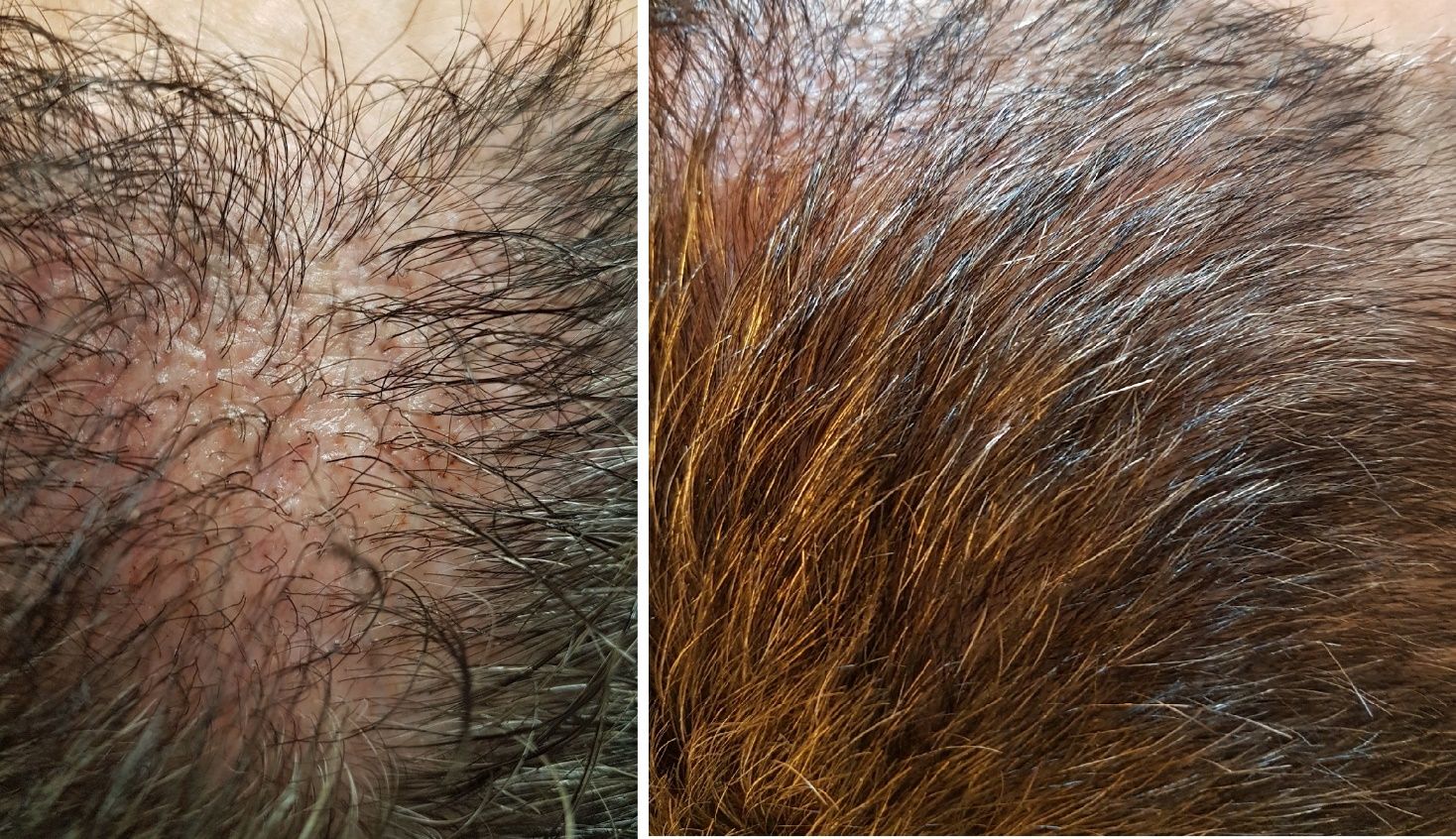 trattamento alopecia con dutasteride