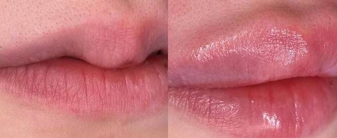 Russian Lips prima e dopo