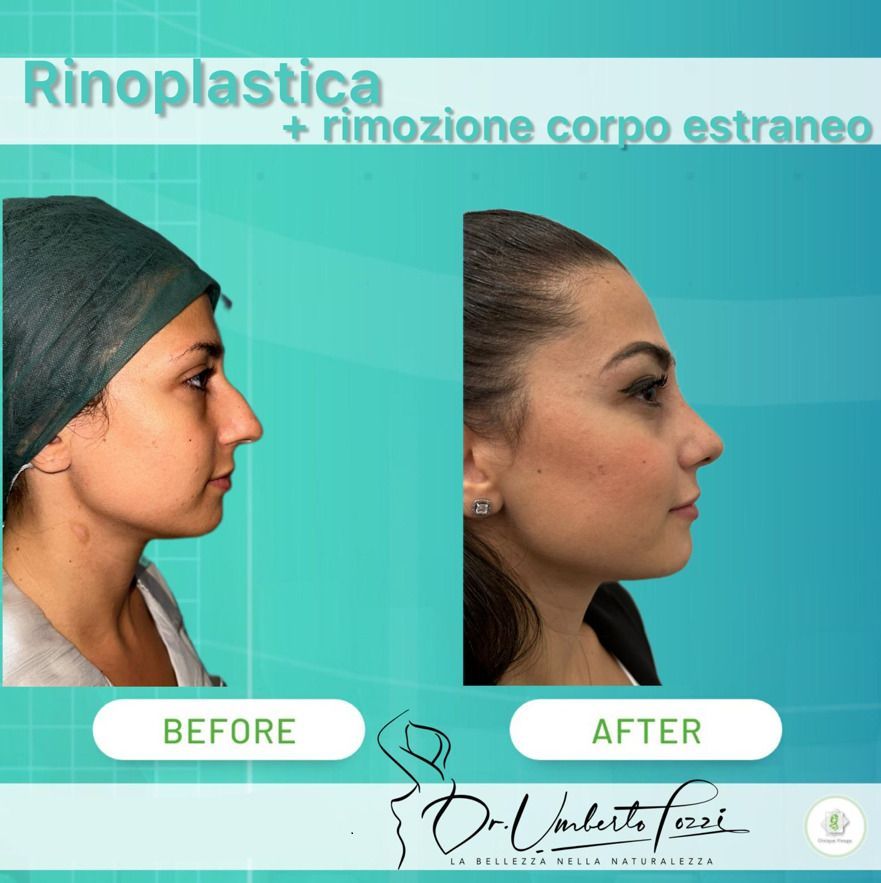 Rinoplastica prima e dopo