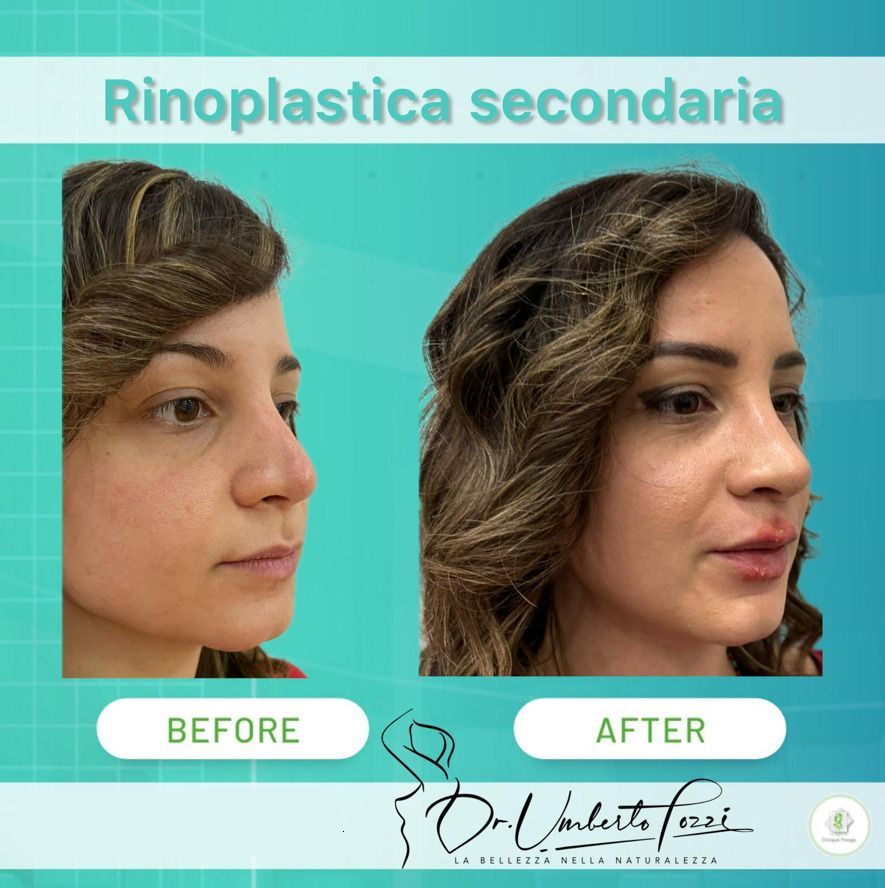 Rinoplastica prima e dopo