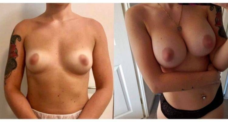 Prima e dopo Mastoplastica Argentina