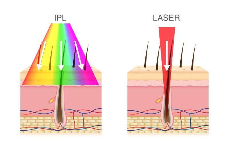 differenza laser e luce pulsata