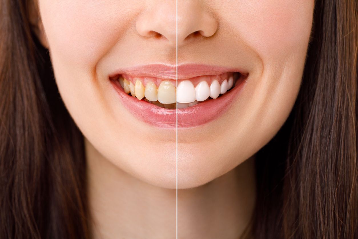 Prima e dopo sbiancamento denti