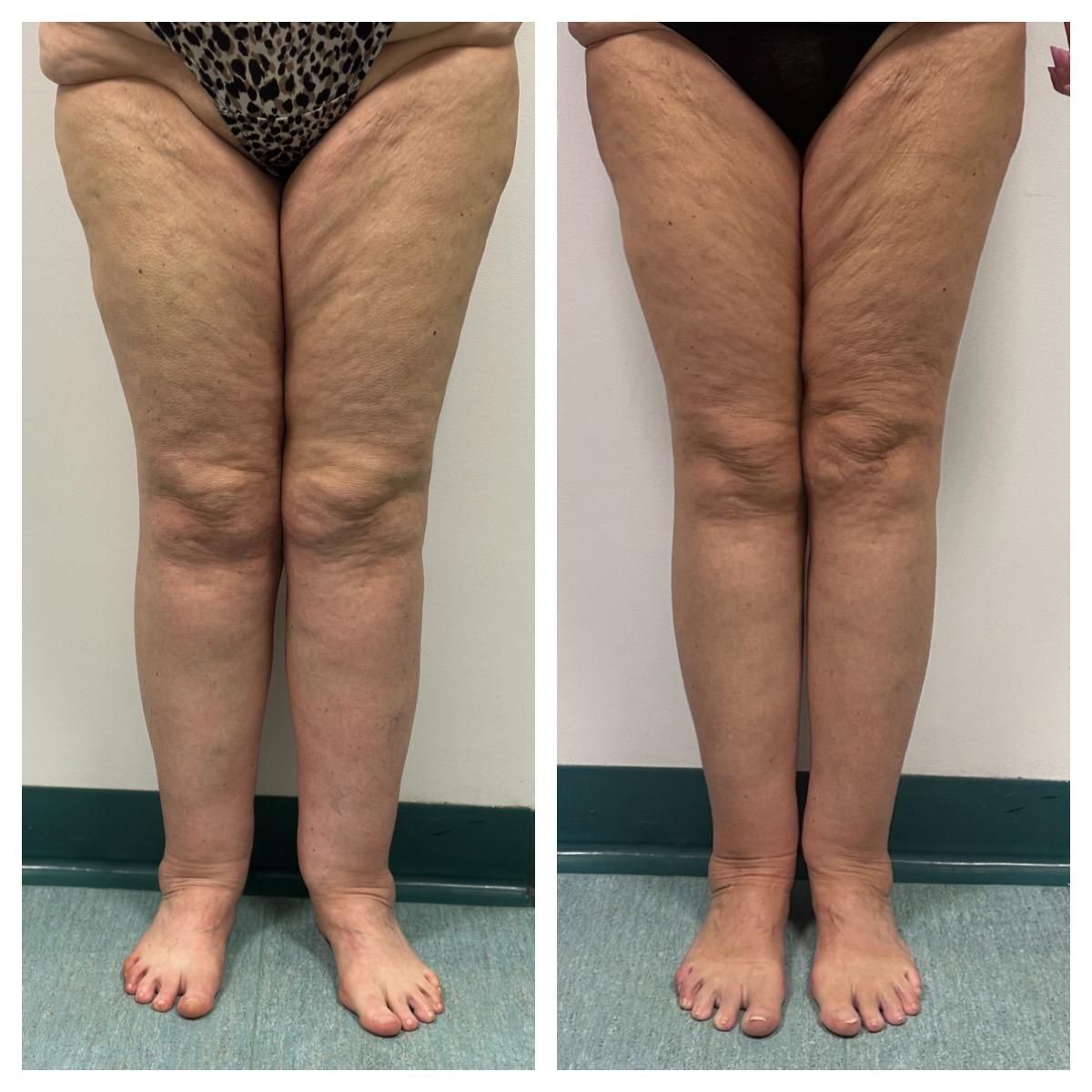 Lipedema prima e dopo