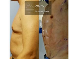 Antes y después de Liposucción con Marcaje Abdominal de alta definición 