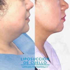 Liposucción de cuello - Dr. Rodrigo Camacho Acosta
