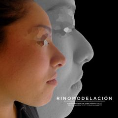 Rinomodelación (aplicación de acido hialuronico en nariz) - Dr. Rodrigo Camacho Acosta