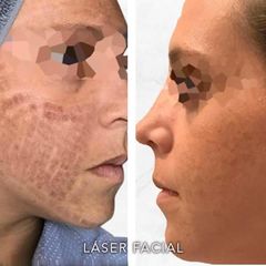 Antes y después de Láser facial 
