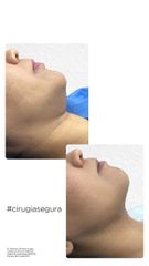 Antes y después de Liposucción de cuello 