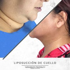 Lipopapada -  Dr. Rodrigo Camacho Acosta