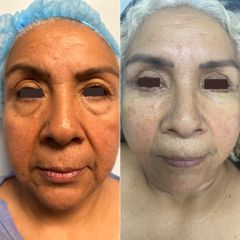 Blefaroplastia - Dr. Rodrigo Camacho Acosta