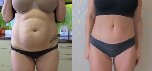 Liposukcja brzucha - przed i po