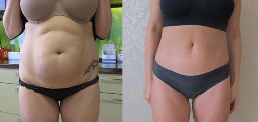 liposukcja