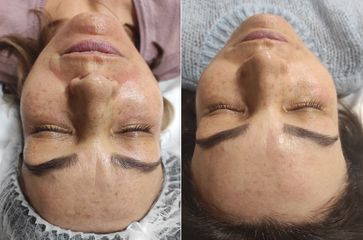 mezoterapia_1
