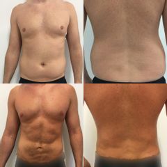 Liposukcja - Dr Dominik K. Boliglowa