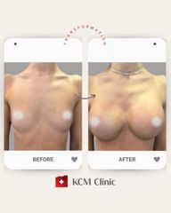 Powiększanie biustu - KCM Clinic Chirurgia Plastyczna i Bariatria